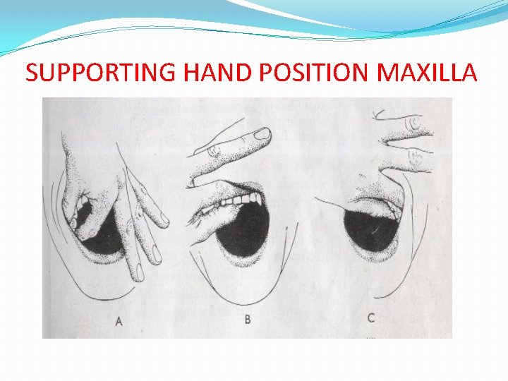 SUPPORTING HAND POSITION MAXILLA 