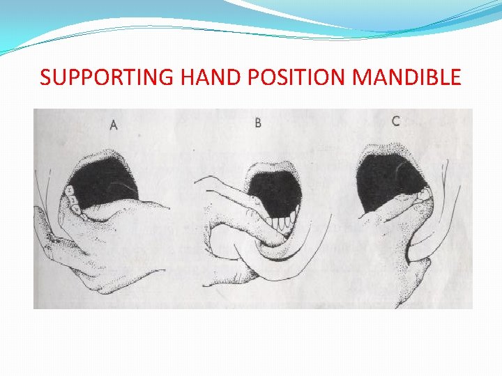 SUPPORTING HAND POSITION MANDIBLE 