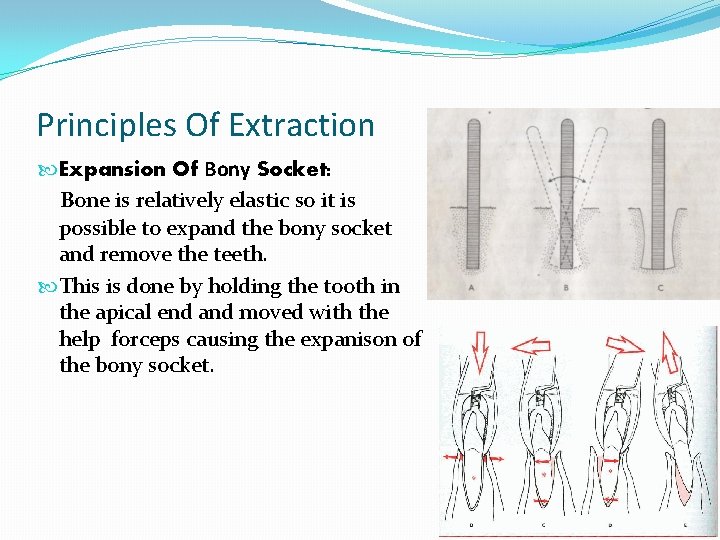 Principles Of Extraction Expansion Of Bony Socket: Bone is relatively elastic so it is