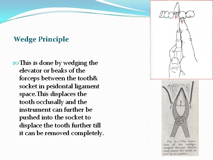 Wedge Principle This is done by wedging the elevator or beaks of the forceps