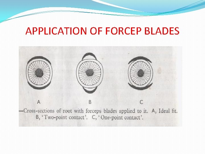 APPLICATION OF FORCEP BLADES 
