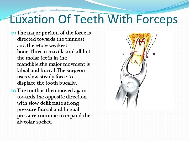 Luxation Of Teeth With Forceps The major portion of the force is directed towards