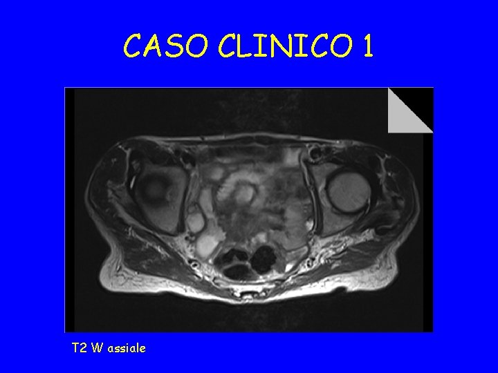 CASO CLINICO 1 T 2 W assiale 