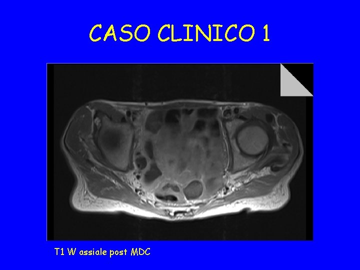 CASO CLINICO 1 T 1 W assiale post MDC 
