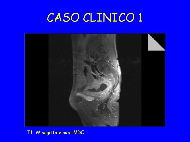 CASO CLINICO 1 T 1 W sagittale post MDC 
