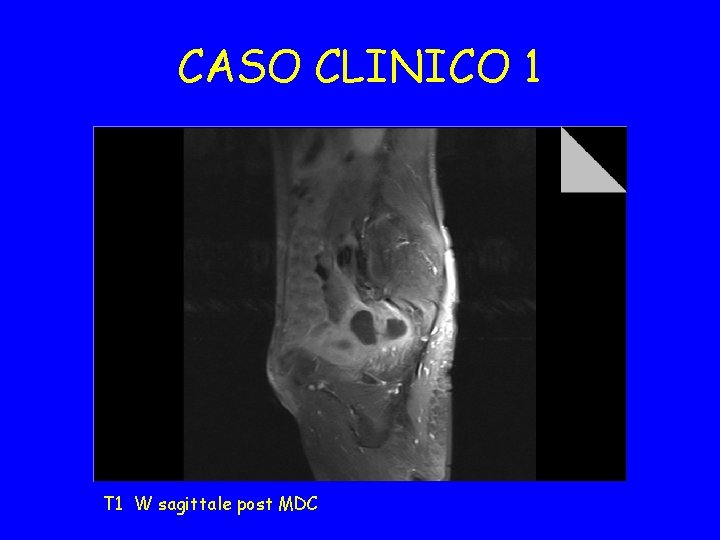CASO CLINICO 1 T 1 W sagittale post MDC 