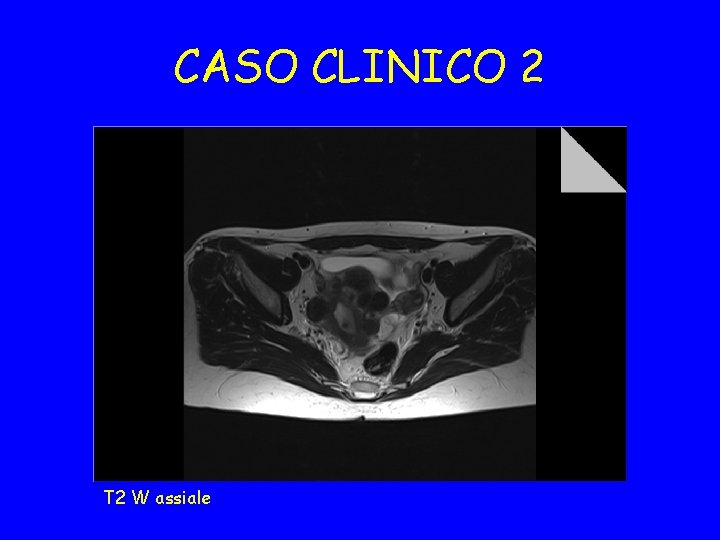 CASO CLINICO 2 T 2 W assiale 