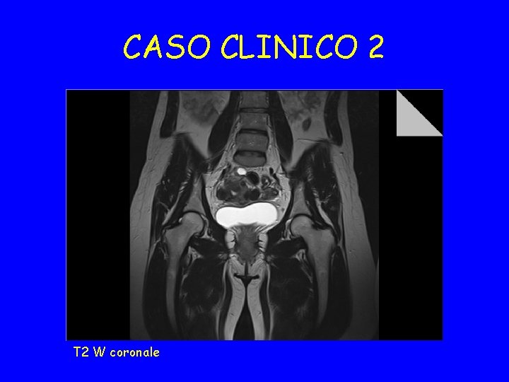 CASO CLINICO 2 T 2 W coronale 