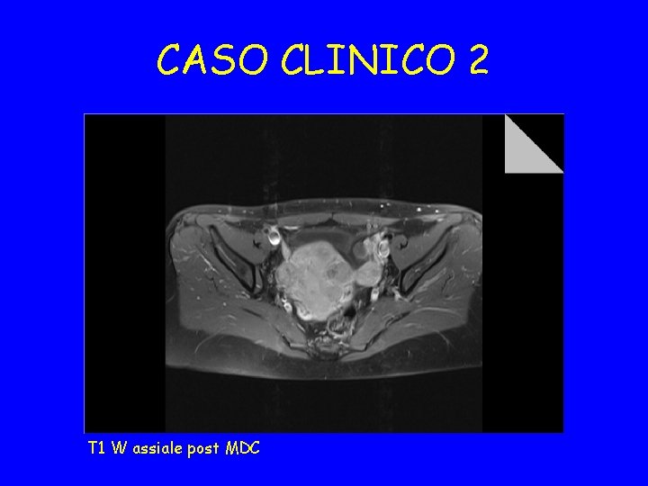 CASO CLINICO 2 T 1 W assiale post MDC 