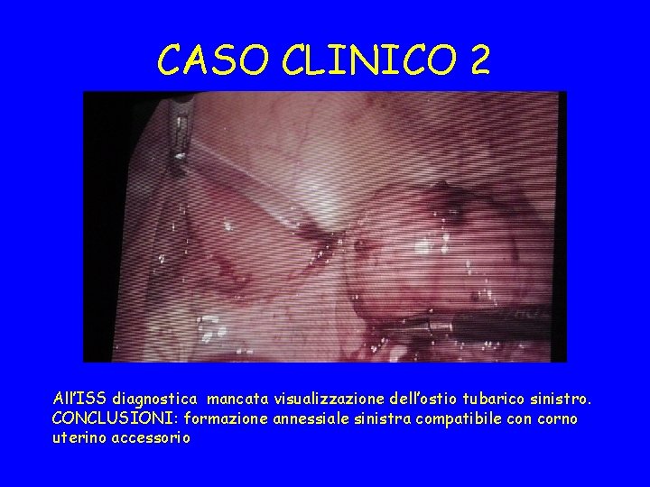 CASO CLINICO 2 All’ISS diagnostica mancata visualizzazione dell’ostio tubarico sinistro. CONCLUSIONI: formazione annessiale sinistra