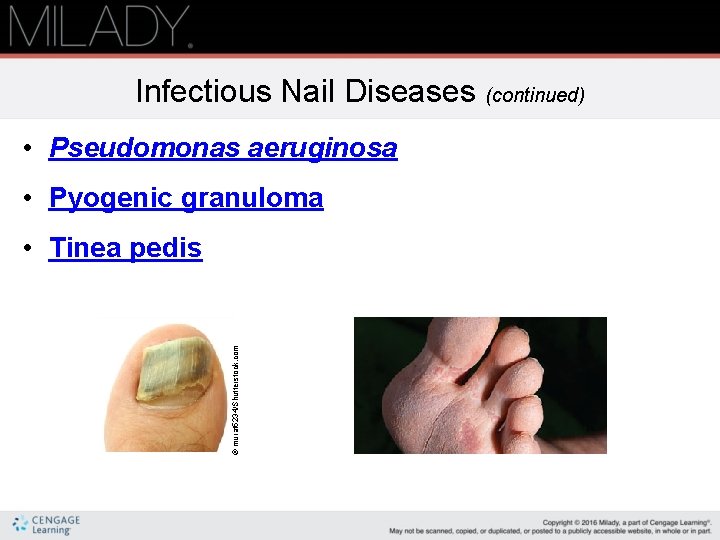 Infectious Nail Diseases (continued) • Pseudomonas aeruginosa • Pyogenic granuloma © murat 5234/Shutterstock. com