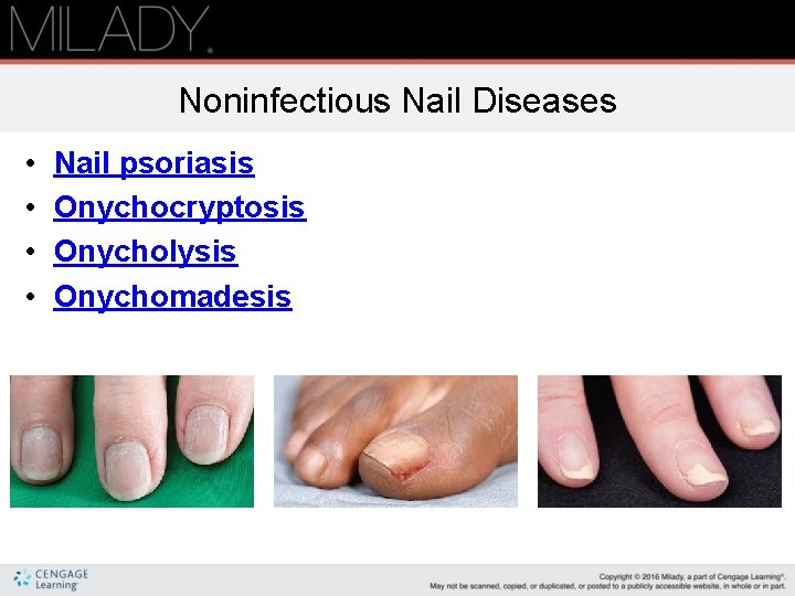 Noninfectious Nail Diseases • • Nail psoriasis Onychocryptosis Onycholysis Onychomadesis 