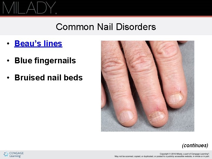 Common Nail Disorders • Beau’s lines • Blue fingernails • Bruised nail beds (continues)