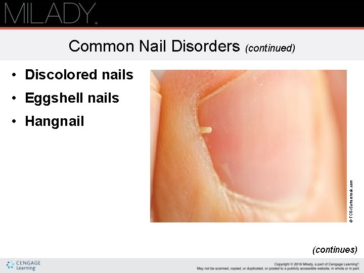 Common Nail Disorders (continued) • Discolored nails • Eggshell nails © FCG/Sutterstock. com •