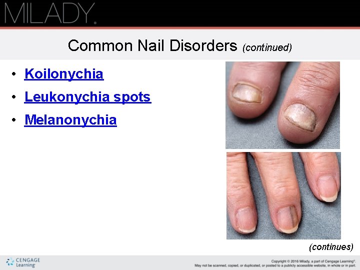 Common Nail Disorders (continued) • Koilonychia • Leukonychia spots • Melanonychia (continues) 