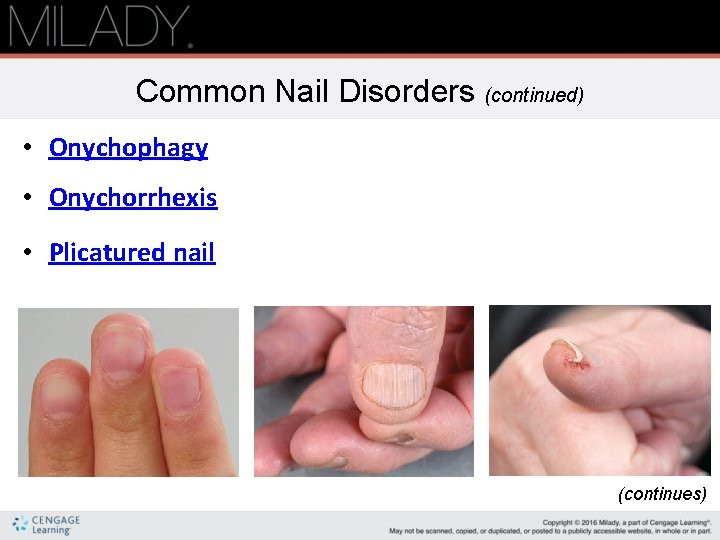 Common Nail Disorders (continued) • Onychophagy • Onychorrhexis • Plicatured nail (continues) 