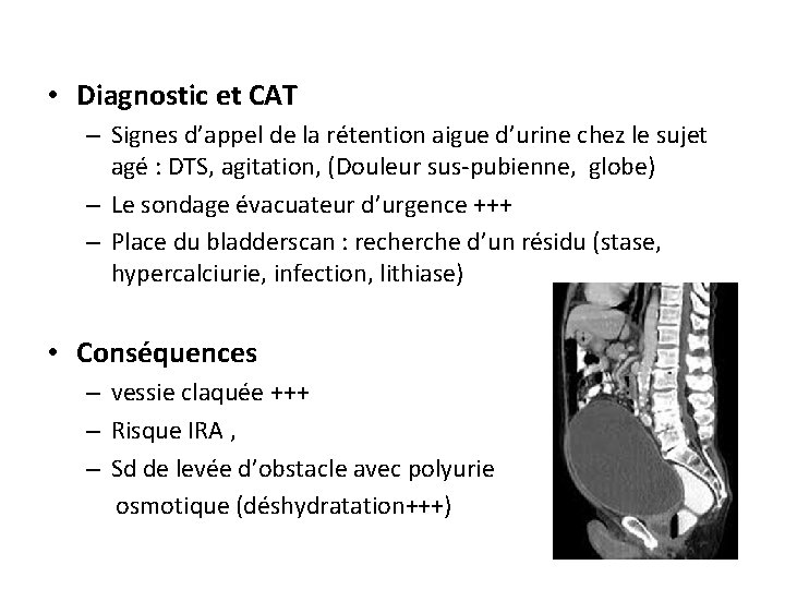  • Diagnostic et CAT – Signes d’appel de la rétention aigue d’urine chez