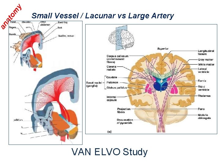 y om at an Small Vessel / Lacunar vs Large Artery VAN ELVO Study