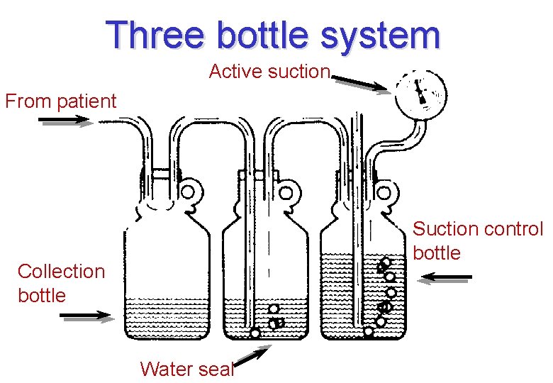 Three bottle system Active suction From patient Suction control bottle Collection bottle Water seal Three bottle system Active suction From patient Suction control bottle Collection bottle Water seal