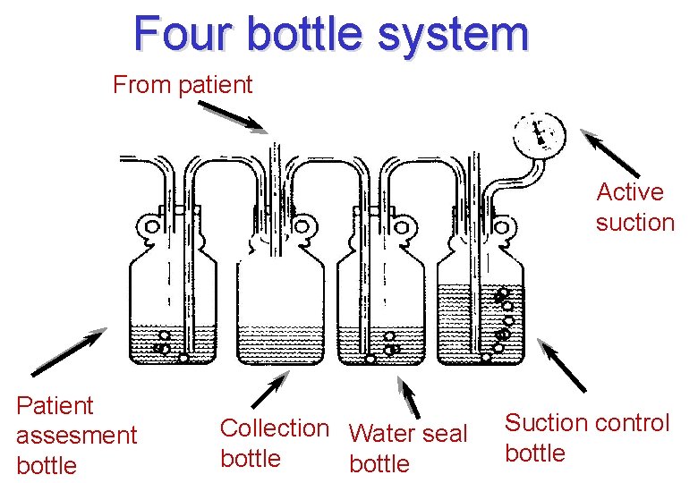 Four bottle system From patient Active suction Patient assesment bottle Collection Water seal bottle