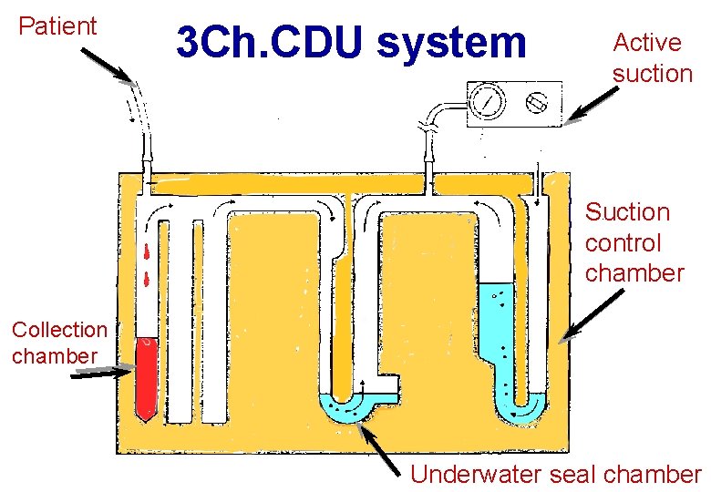 Patient 3 Ch. CDU system Active suction Suction control chamber Collection chamber Underwater seal Patient 3 Ch. CDU system Active suction Suction control chamber Collection chamber Underwater seal