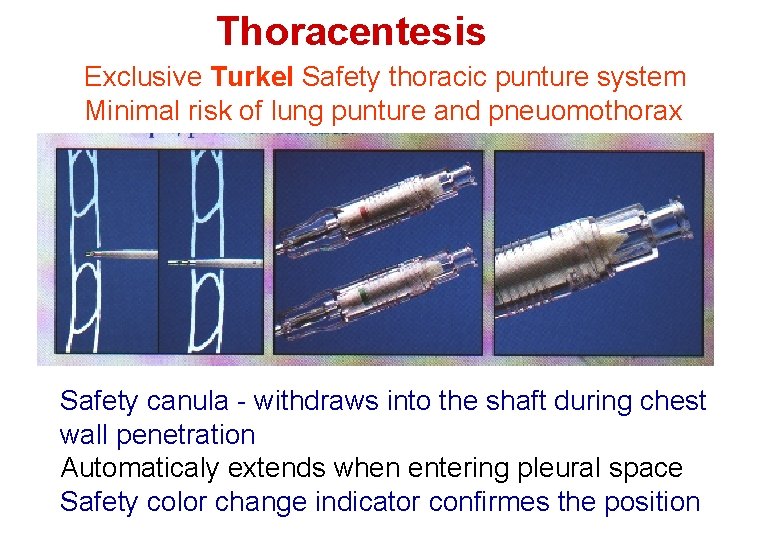 Thoracentesis Exclusive Turkel Safety thoracic punture system Minimal risk of lung punture and pneuomothorax