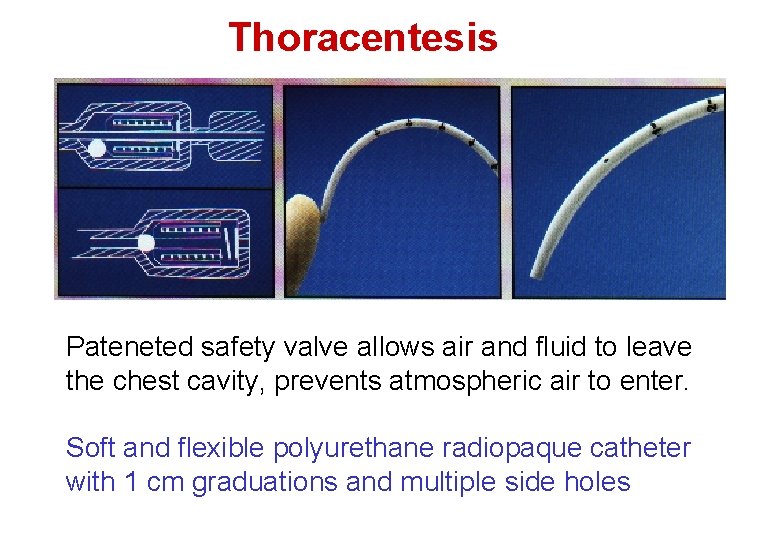 Thoracentesis Pateneted safety valve allows air and fluid to leave the chest cavity, prevents Thoracentesis Pateneted safety valve allows air and fluid to leave the chest cavity, prevents