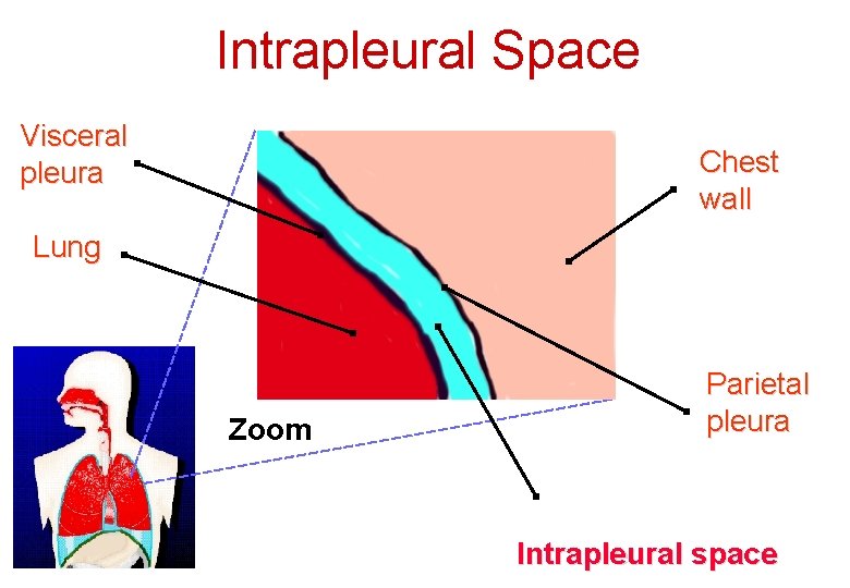 Intrapleural Space Visceral pleura Chest wall Lung Zoom Parietal pleura Intrapleural space 