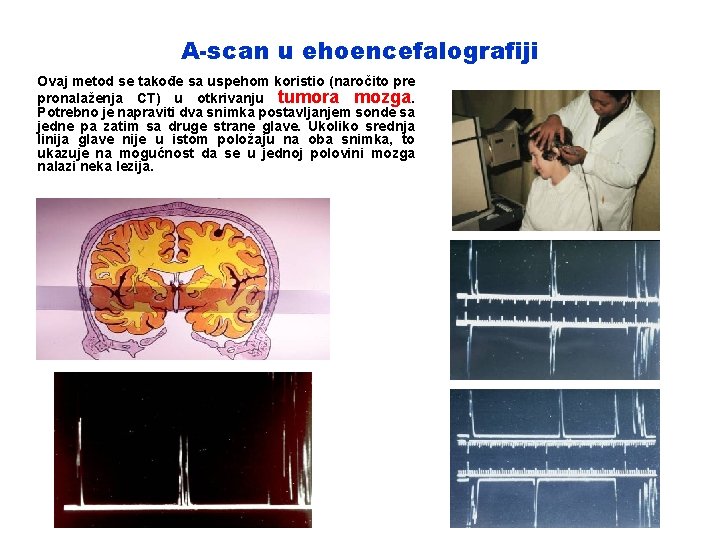 A-scan u ehoencefalografiji Ovaj metod se takođe sa uspehom koristio (naročito pre pronalaženja CT)