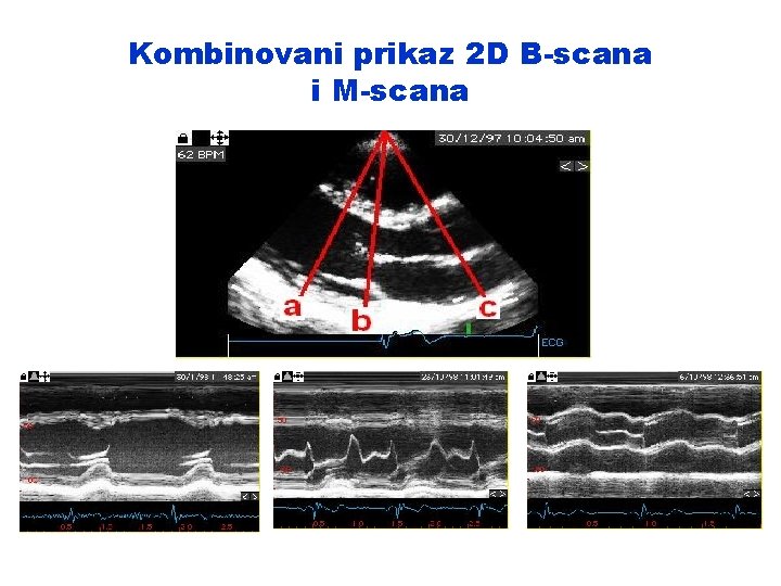 Kombinovani prikaz 2 D B-scana i M-scana 