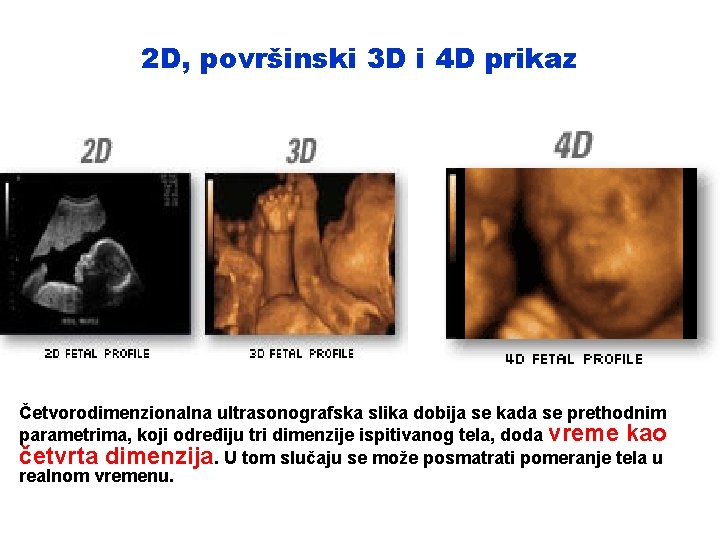 2 D, površinski 3 D i 4 D prikaz Četvorodimenzionalna ultrasonografska slika dobija se