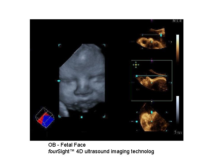 OB - Fetal Face four. Sight™ 4 D ultrasound imaging technolog 
