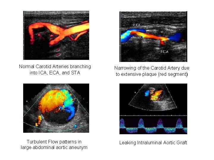 Normal Carotid Arteries branching into ICA, ECA, and STA Narrowing of the Carotid Artery