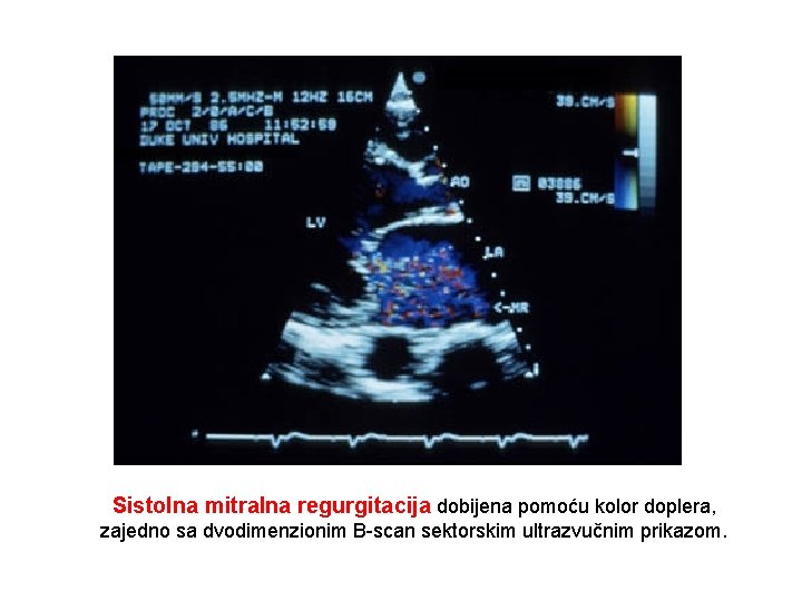 Sistolna mitralna regurgitacija dobijena pomoću kolor doplera, zajedno sa dvodimenzionim B-scan sektorskim ultrazvučnim prikazom.