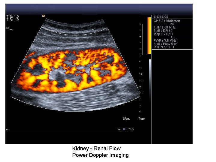 Kidney - Renal Flow Power Doppler Imaging 