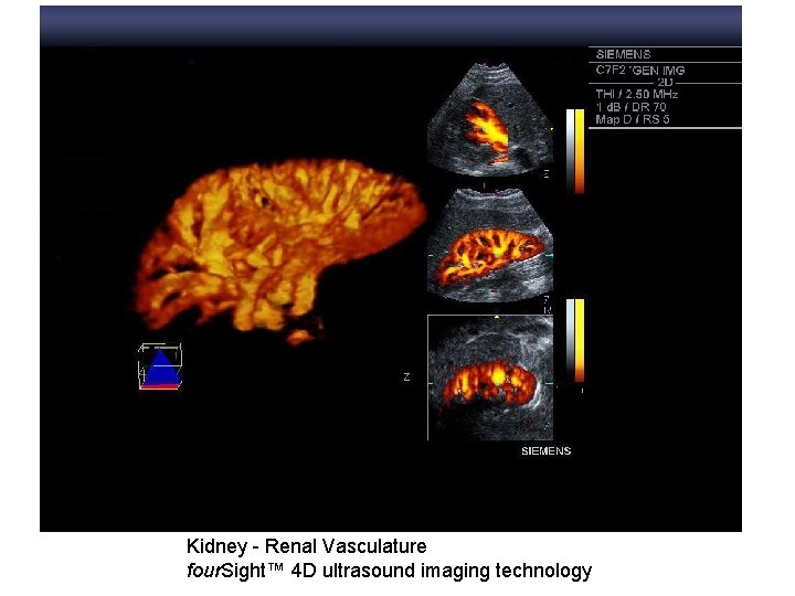 Kidney - Renal Vasculature four. Sight™ 4 D ultrasound imaging technology 