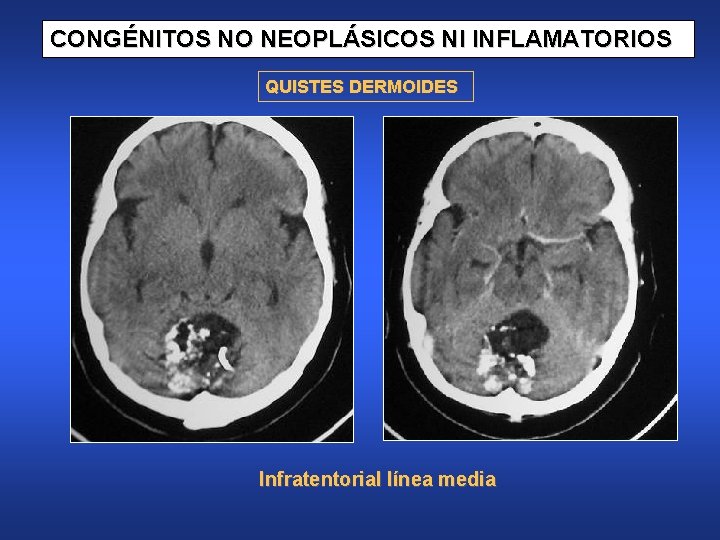 CONGÉNITOS NO NEOPLÁSICOS NI INFLAMATORIOS QUISTES DERMOIDES Infratentorial línea media 