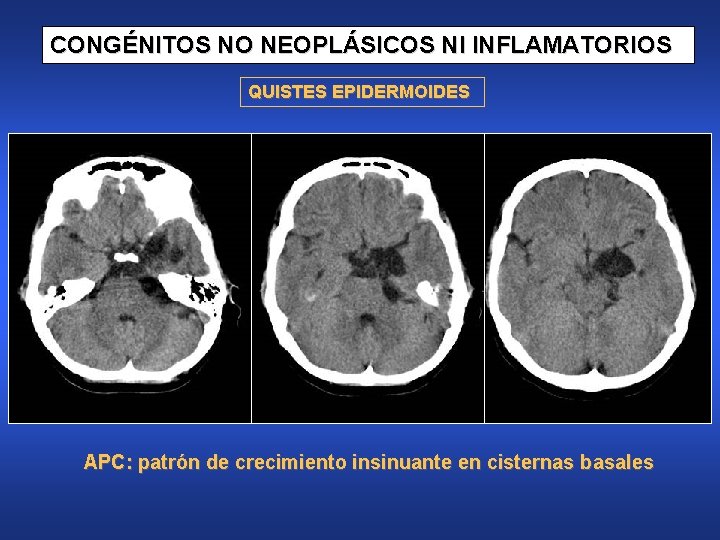 CONGÉNITOS NO NEOPLÁSICOS NI INFLAMATORIOS QUISTES EPIDERMOIDES APC: patrón de crecimiento insinuante en cisternas