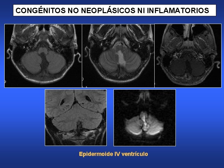 CONGÉNITOS NO NEOPLÁSICOS NI INFLAMATORIOS Epidermoide IV ventrículo 