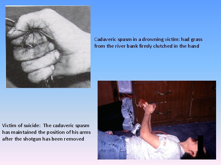 Cadaveric spasm in a drowning victim: had grass from the river bank firmly clutched