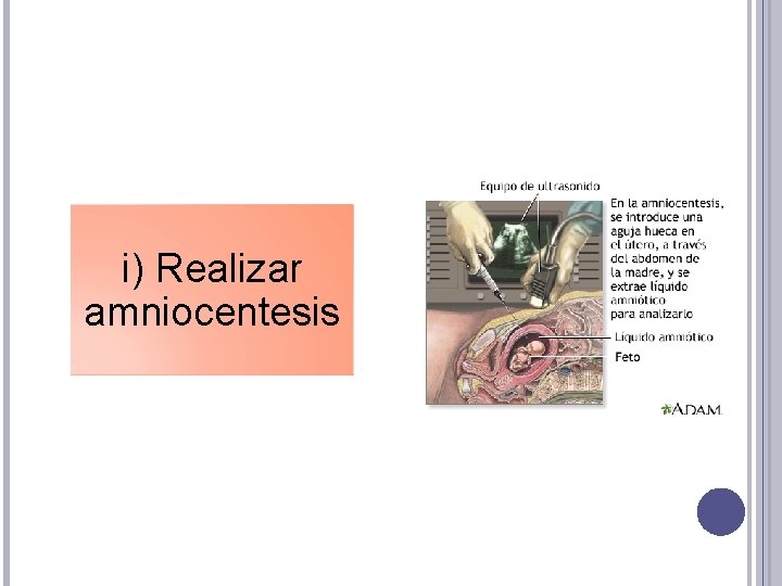 i) Realizar amniocentesis 