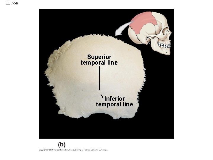 LE 7 -5 b Superior temporal line Inferior temporal line LE 7 -5 b Superior temporal line Inferior temporal line