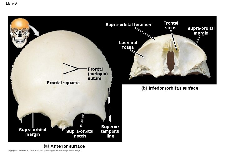 LE 7 -6 Supra-orbital foramen Frontal sinus Supra-orbital margin Lacrimal fossa Frontal squama Frontal LE 7 -6 Supra-orbital foramen Frontal sinus Supra-orbital margin Lacrimal fossa Frontal squama Frontal