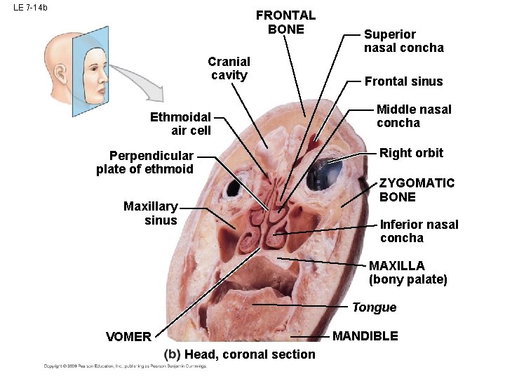 LE 7 -14 b FRONTAL BONE Cranial cavity Ethmoidal air cell Perpendicular plate of LE 7 -14 b FRONTAL BONE Cranial cavity Ethmoidal air cell Perpendicular plate of