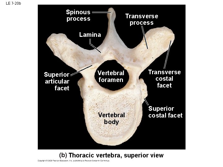 LE 7 -20 b Spinous process Transverse process Lamina Superior articular facet Vertebral foramen LE 7 -20 b Spinous process Transverse process Lamina Superior articular facet Vertebral foramen