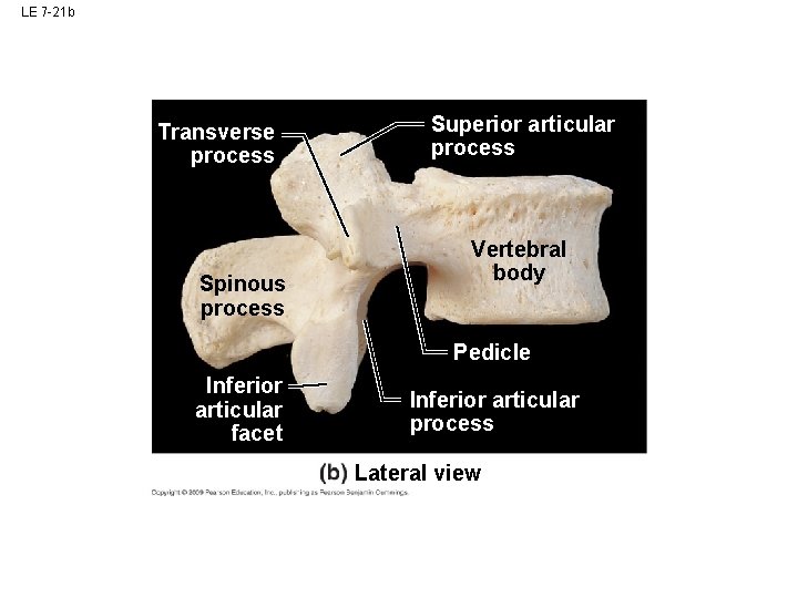 LE 7 -21 b Transverse process Spinous process Superior articular process Vertebral body Pedicle LE 7 -21 b Transverse process Spinous process Superior articular process Vertebral body Pedicle