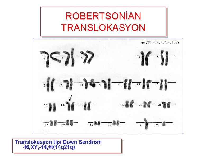 ROBERTSONİAN TRANSLOKASYON Translokasyon tipi Down Sendrom 46, XY, -14, +t(14 q 21 q) 