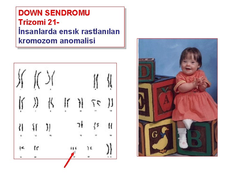 DOWN SENDROMU Trizomi 21İnsanlarda ensık rastlanılan kromozom anomalisi 