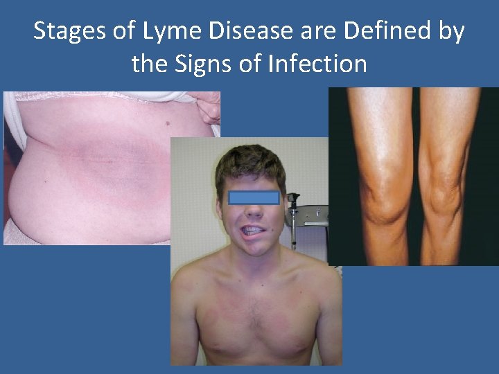 Stages of Lyme Disease are Defined by the Signs of Infection 