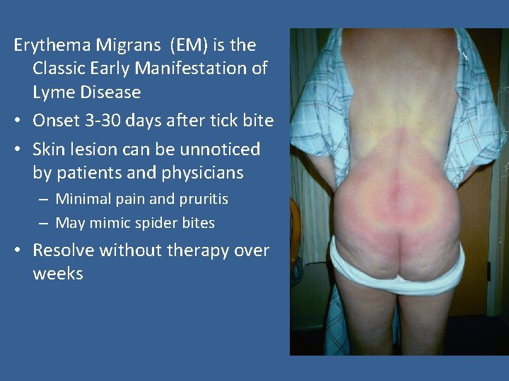 Erythema Migrans (EM) is the Classic Early Manifestation of Lyme Disease • Onset 3